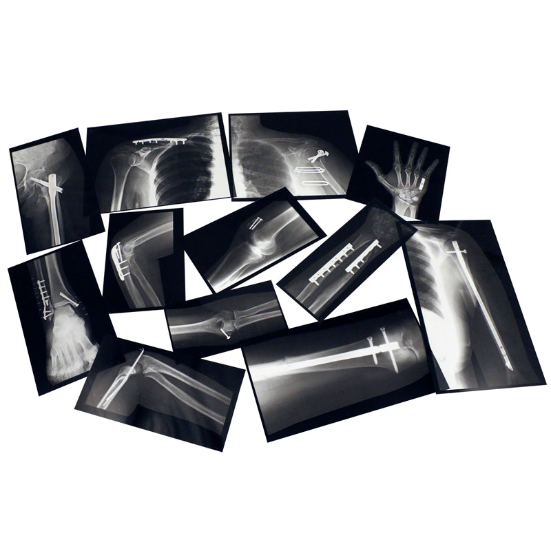 FIXED BONES X-RAYS
